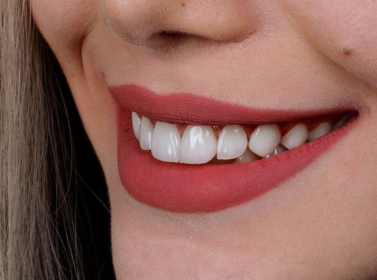 Clareamento dental