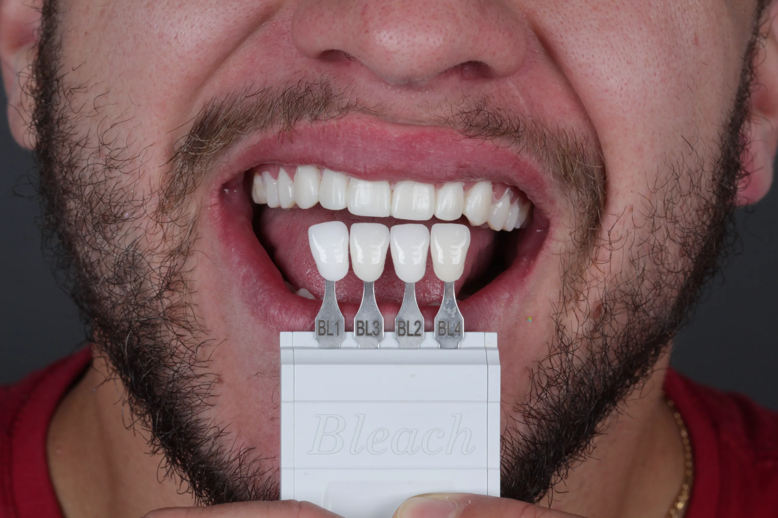 Facetas dentárias em porcelana