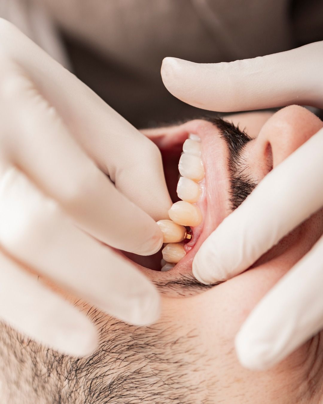 Implantes dentários